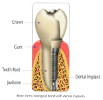 implant2